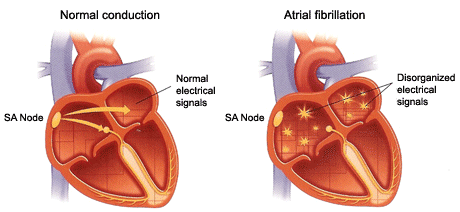 Pictures of atrial fibrillation